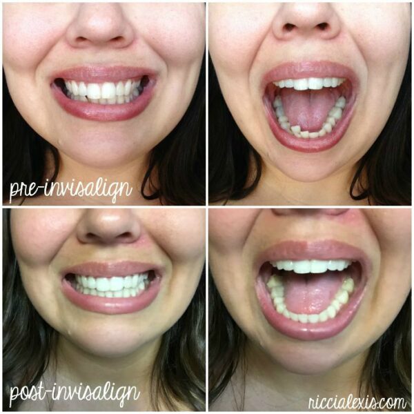 It's Invisalign Party Time at Arkansas Family Dental!