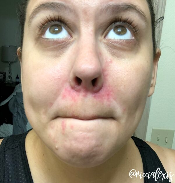 perioral-dermatitis-update-january-2019